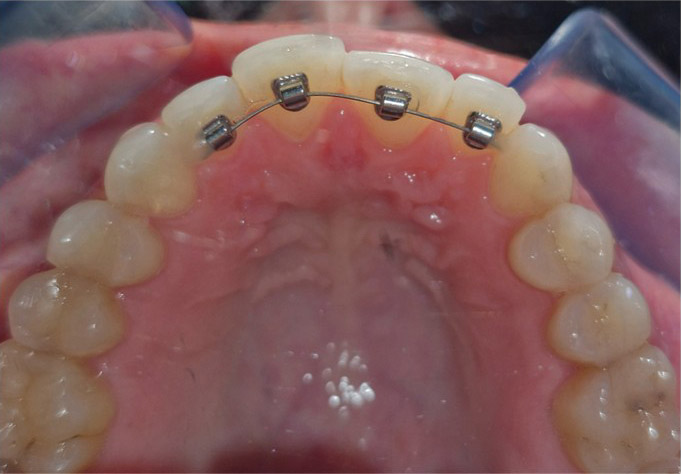 NiTi arch wire