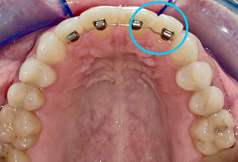 Ultra-light CL II elastics 